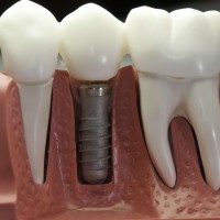 Dental Crowns