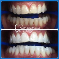 Teeth Whitening Sydney