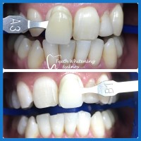 Teeth Whitening Sydney