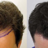 Rahal Hair Transplant Toronto