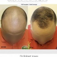 Dr Robert Jones - Toronto Hair Transplant Center