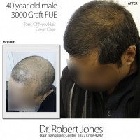 Dr Robert Jones - Toronto Hair Transplant Center