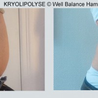 Well Balance Hamburg – Kryolipolyse, Wingwave Coaching und Lipo Laser