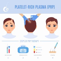 Welona Clinic - PRP Hair Loss Treatment