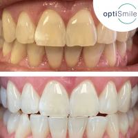 OptiSmile Advanced Dentistry and Implant Centre