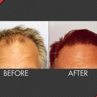 MAXiM Hair Restoration