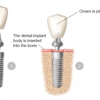 Hungary Dental Implant