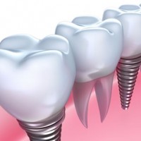 Hungary Dental Implant