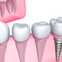 Hungary Dental Implant