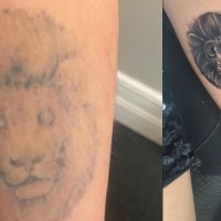 Tattoo Removal Manchester