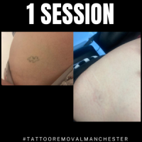 Tattoo Removal Manchester