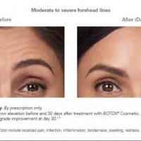 Bergen County Botox By Lasting Impression