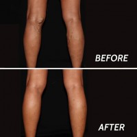 Varicose Veins Ridgewood