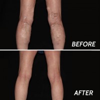 Varicose Veins Ridgewood