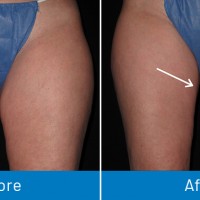 Varicose Veins Ridgewood