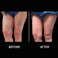 Varicose Veins Ridgewood