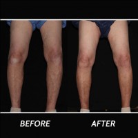 Varicose Veins Ridgewood