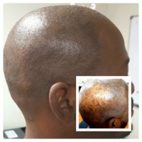 Scalp International Hairlines