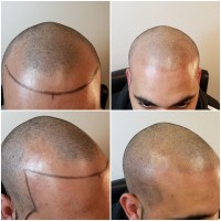 Scalp International Hairlines