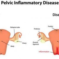 Pelvic inflammatory disease treatment in New York