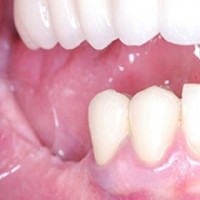 OC Dental Implants