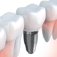 OC Dental Implants