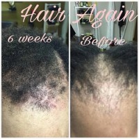 HAIR AGAIN CERTIFIED HAIR LOSS SPECIALISTS