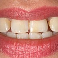 Invisalign Brooklyn