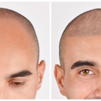 Complete Micropigmentation