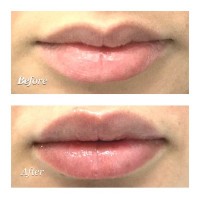 Best Lip Filler & Injections