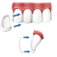 Dental Veneers