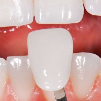 Dental Veneers