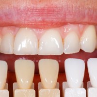 Dental Veneers