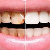 Dental Veneers