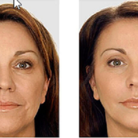 Botox Treatment Long Island