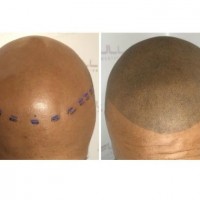 Full Micropigmentation